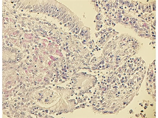 Acid fast bacteria acc. Ziehl - Neelsen